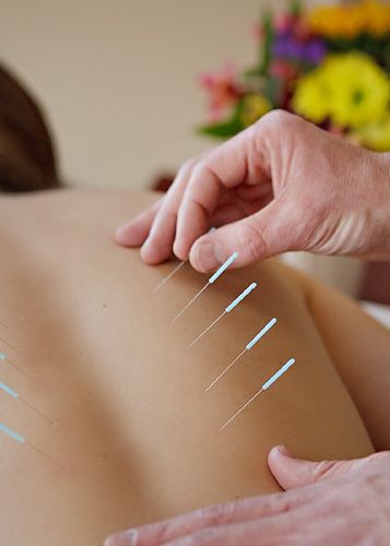Acupressure Therapy
