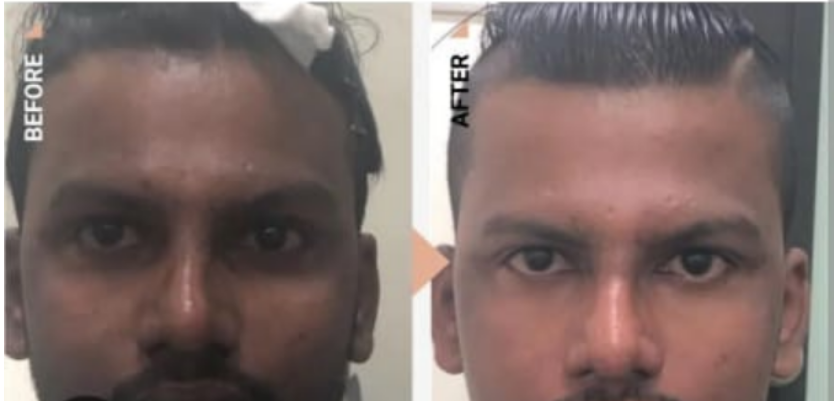 Skin-whitening